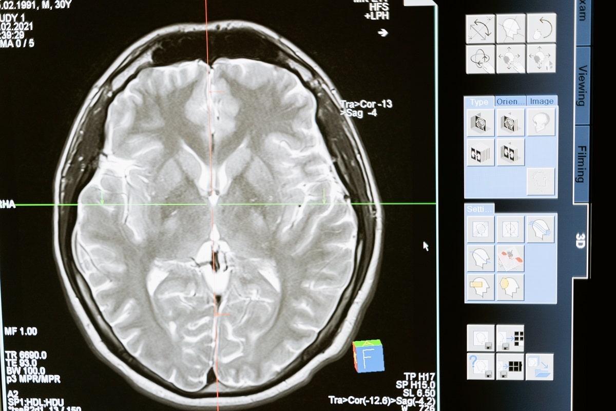 Types of Brain Tumors and Effective Treatment