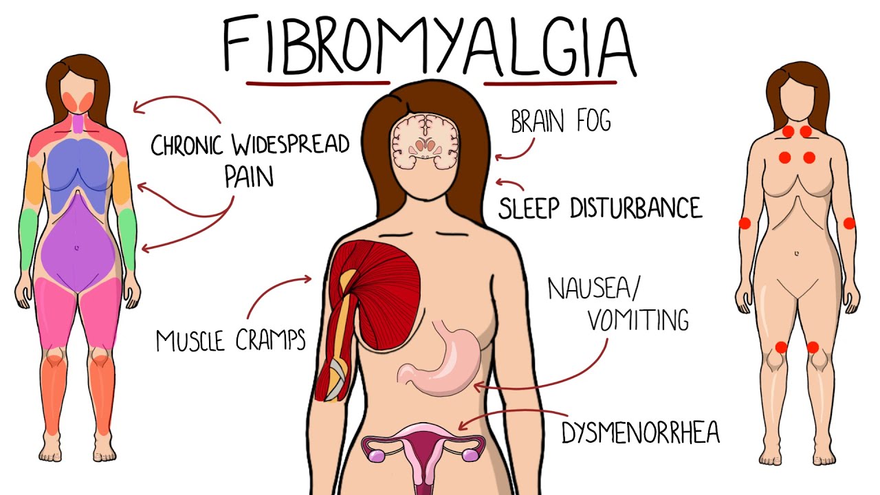 Fibromyalgia is an often misunderstood illness. It targets your muscles and joints, which can lead to a lot of problems. There are no known causes for Fibromyalgia, but many believe that genetics may play a role. Symptoms include pain and tenderness in your muscles and joints, as well as fatigue. Treatment typically includes medications, physical therapy, and lifestyle changes.