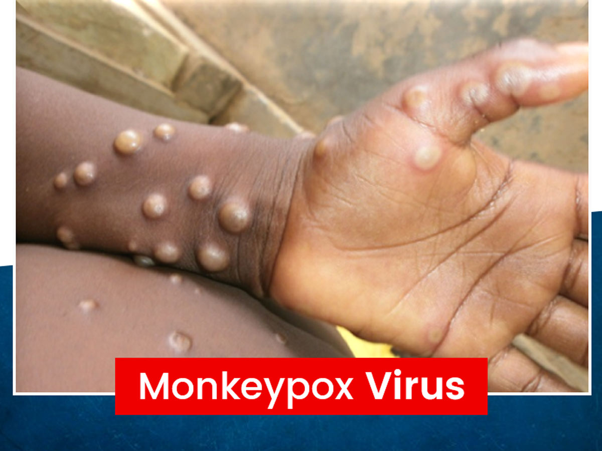 Monkeypox Virus another threat in 2022