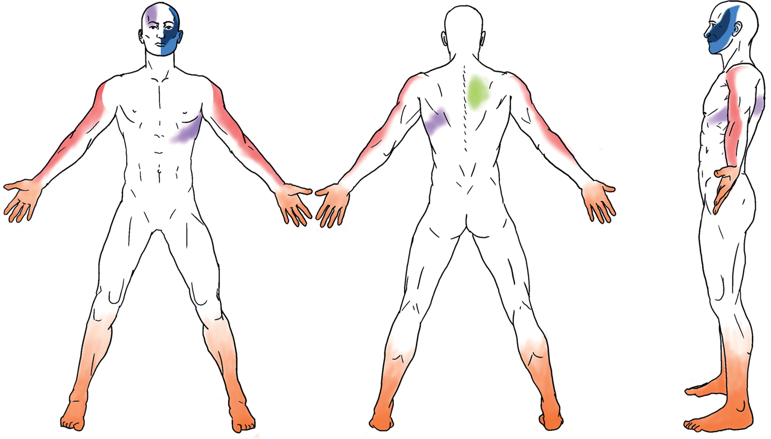 Neuropathic Itch