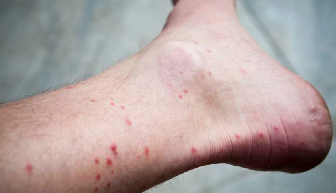 If you are looking for a cure for lichen planus, there are many different treatments available at your disposal. So don't be discouraged; there is definitely a solution out there for you.