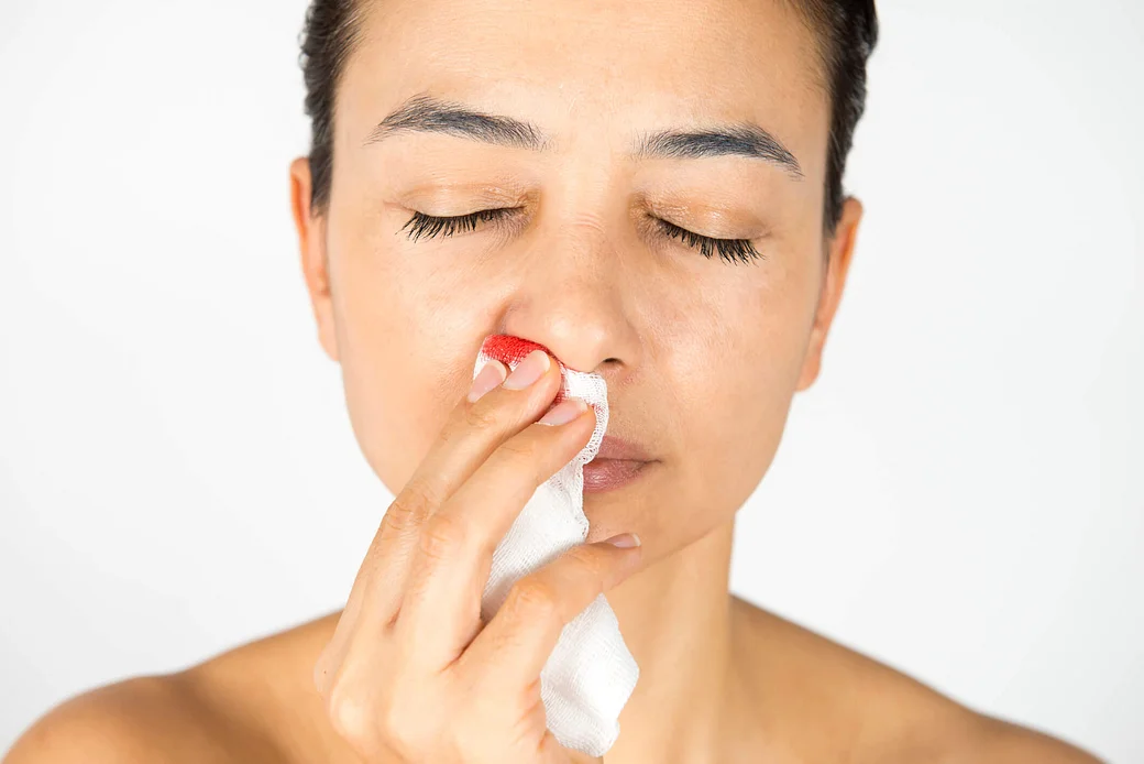 home remedies for nose bleedings