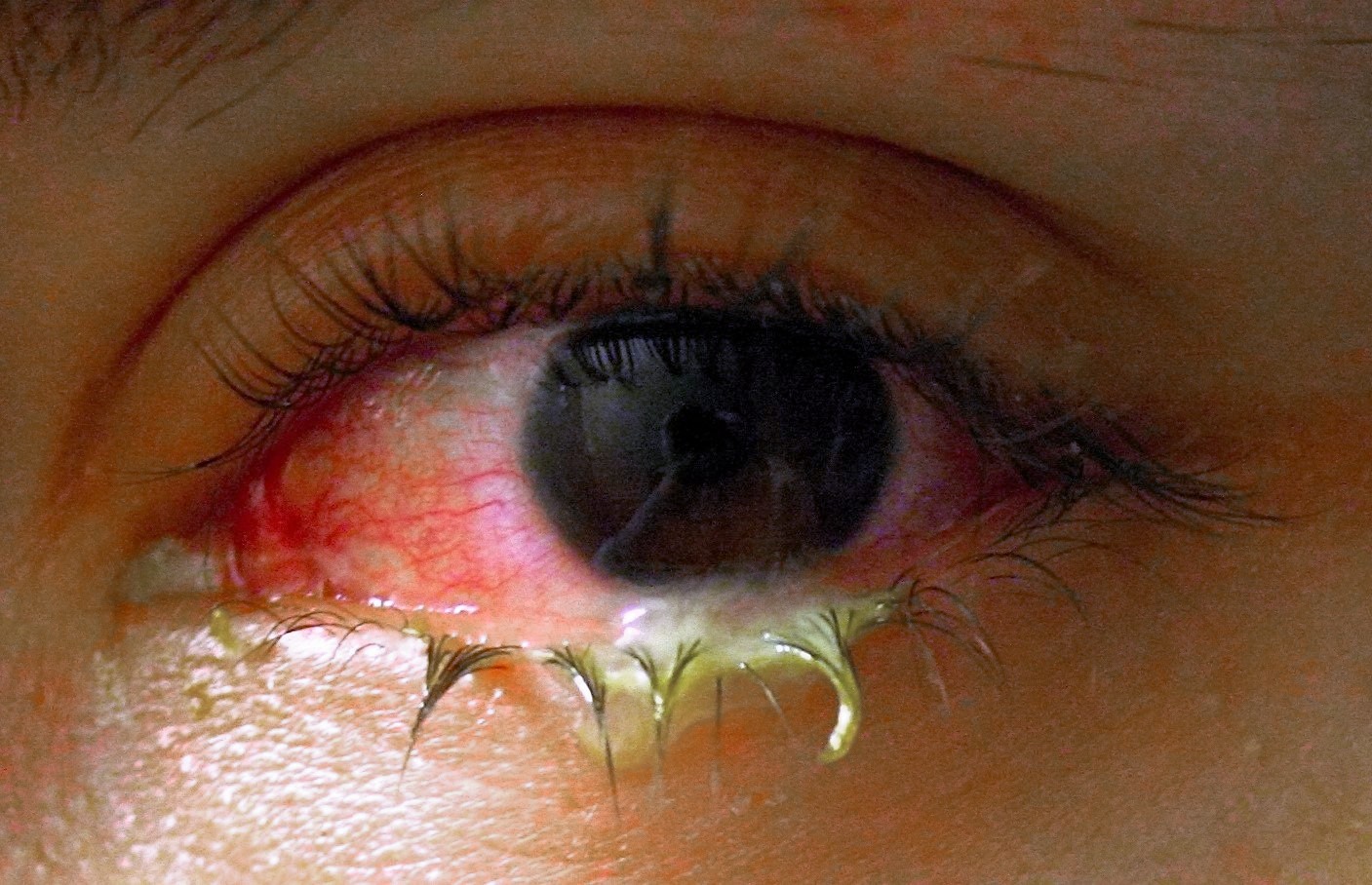 Conjunctivitis