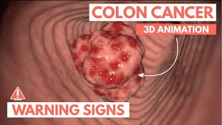 5 warning signs of Colon Cancer | 3D Animation