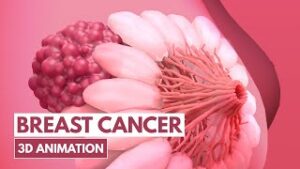 5 Signs of Breast cancer | 3D Animation