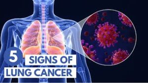 5 Signs of Lung Cancer | 3D Animation
